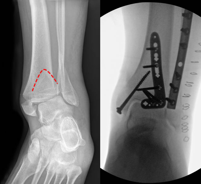 Complex ankle fracture